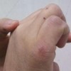 冻疮有哪些治疗及预防方法