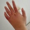 冬季经常穿靴子容易长冻疮