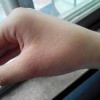 冻疮的预防与中药治疗