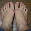 手上生冻疮