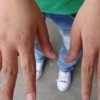 冻疮溃烂要重视良好前往医院诊治
