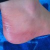 刚长冻疮应该怎么办