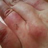 季节性冻疮怎么治