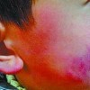 一旦的了冻疮到底要如何治疗呢