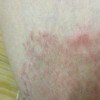 体癣护理方法介绍