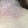 体癣患者要注意哪些问题