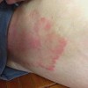 体癣的食疗方法