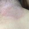 体癣患者如何护理