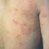 体癣患者能不能养宠物