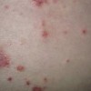 女性患病体癣该如何护理呢