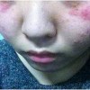 湿气重导致过敏性鼻炎发作怎么办
