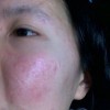 脸上过敏红痒怎么办