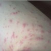 面部过敏的治疗方法