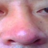 酒糟鼻的预防方法