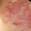 脓疱疮患者锻炼身体的方法