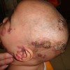 做好护理对新生儿脓疱疮很重要