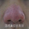 怎样治疗酒糟鼻较好
