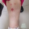 预防及治疗脓疱疮