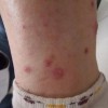 预防儿童皮肤生脓疱疮
