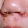 预防脓疱疮 日常生活需注意这些