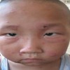 识别脓疱疮宝妈别再束手无策