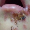 如何治疗新生儿的脓疱疮