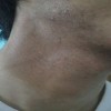 哪些细节能引起青春痘的发生呢