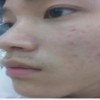 导致青春痘的四大原因