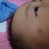 青春痘难道会传染吗