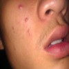 青春痘治愈后会留疤吗