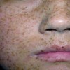 常见的几种皮肤斑点及其防治方法