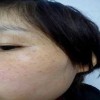 哪里祛斑效果好色斑反复出现怎么办