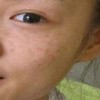 色斑预示哪些健康问题