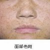 去色斑多少钱