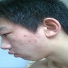 大家对青春痘的常识是否清楚