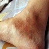 过敏性紫癜如何有效防治