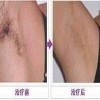 腋臭对患者带来哪些不便和困惑