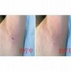 腋臭专家的自我诊断方法是什么