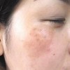 怎样才能有效预防黄褐斑的发病