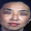 关于黄褐斑恶习的危害