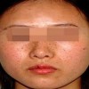 黄褐斑分为哪些类型呢