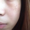 黄褐斑给患者带来哪些危害
