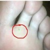 鸡眼与胼胝的主要鉴别点