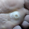 跖疣症状和鸡眼如何区别