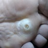 鸡眼与哪些疾病容易混淆呢