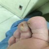 怎么判断是鸡眼