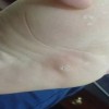 诊断鸡眼及预防鸡眼的注意事项