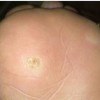 如何鉴别诊断鸡眼