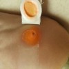 为什么得了鸡眼不能乱挑