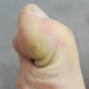 手上长鸡眼是因为什么呢